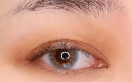 国产成人A在线观看视频免费:双眼皮手术最新,双眼皮手术最新趋势与国产成人A在线观看视频免费，探索美的多重维度