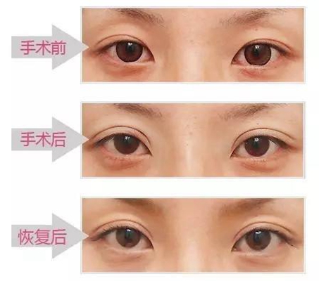 国产成人A在线观看视频免费:双眼皮手术最新,双眼皮手术最新趋势与国产成人A在线观看视频免费，探索美的多重维度